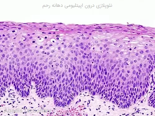 نئوپلازی درون اپیتلیومی دهانه رحم